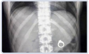 swallowed-engagement-ring-xray